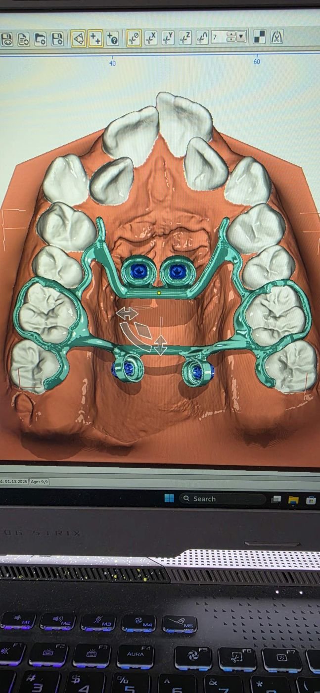 Disjunctor pe mini-implanturi proiectat în 3D, pe modelul pacientului